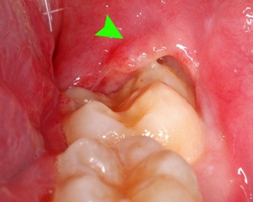 sưng nướu răng trong cùng hàm dưới