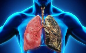 ung thư phổi giai đoạn cuối