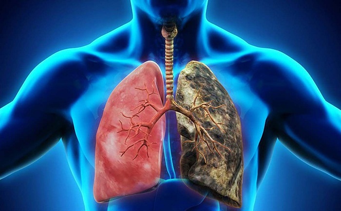 ung thư phổi giai đoạn cuối